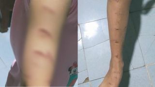 Lời khai người chị họ dùng dao rạch khắp người bé gái lớp 5, gia đình đưa ra hướng giải quyết
