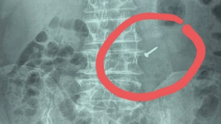 Người đàn ông nuốt phải chiếc đinh sắt nhọn vì thói quen khó bỏ, gia đình sững sờ khi phát hiện