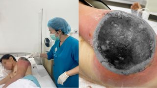 Người đàn ông suýt mất cả cánh tay vì đắp lá chữa chấn thương theo mẹo dân gian