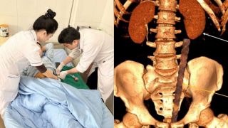 Quảng Ninh: Cấp cứu ca tai nạn hy hữu bị cọc sắt xuyên thấu ổ bụng sâu 30cm, hiện sức khỏe ra sao?