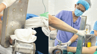 Bàn tay người phụ nữ cuốn chặt vào máy xay: Bác sĩ có quyết định khẩn để bảo vệ tính mạng bệnh nhân