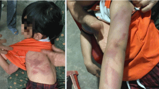 Bé gái lớp 2 bị bạn nam cùng lớp đánh bầm tím khắp người vì không ‘giữ lời hứa’, tình hình nạn nhân?