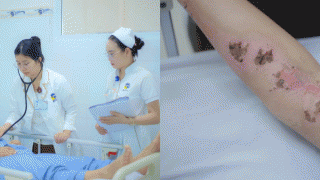 Tình hình hiện tại của cô gái bị sét đánh dẫn đến xuất huyết não? Bác sĩ chỉ cách tránh sét khi trời giông