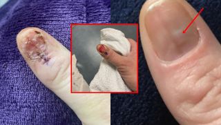 Thợ nail cứu sống 1 cô gái khi phát hiện vệt bầm trên móng tay, sửng sốt khi nhận kết quả chuẩn đoán