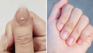 Cẩn thận với loạt dấu hiệu trên móng tay có thể là biểu hiện của bệnh tật mà ít người để ý