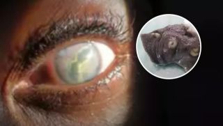 Người phụ nữ kinh hoàng khi phát hiện ký sinh trùng 'giống giun' sống trong mắt suốt hai năm