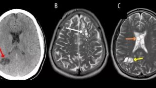 Người đàn ông phát hiện sán dây trong não vì 1 thói quen ăn uống nhiều người mắc phải