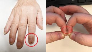 Cụ ông 76 tuổi bị sưng tấy ngón trỏ, đến khám bác sĩ thở dài hóa ra là căn bệnh này