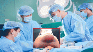 Cằm của nam thanh niên ‘phát sáng’ do tiêm filler, tình trạng hiện tại sau ca phẫu thuật khẩn cấp?