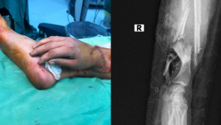 Bàn tay đứt lìa được ‘cấy tạm’ vào chân: Toàn bộ quá trình ghép tay đặc biệt, cứu cô gái mang song thai ở TP.HCM