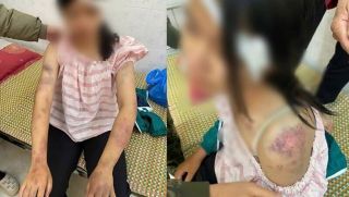 Tình hình sức khỏe của bé gái bị bà nội và người thân bạo hành dã man vì nghi ăn trộm tiền