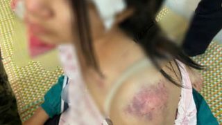 Đã có kết quả giám định thương tật vụ bé gái bị bà nội và 2 người đàn ông hành hạ gây bức xúc