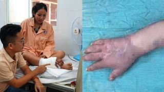 Hành trình phẫu thuật nối lại tay đứt lìa sau ghép tạm vào chân cho thai phụ: Bác sĩ thông tin tình trạng hiện tại