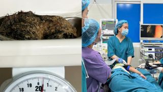 Bé gái 6 tuổi ở Quảng Ngãi nuốt nửa cân tóc, bác sĩ chuẩn đoán hội chứng hiếm gặp