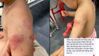 Bé hơn 2 tuổi chi chít vết bầm tím sau giờ học, lời giải thích gây tranh cãi từ giáo viên mầm non và nhà trường