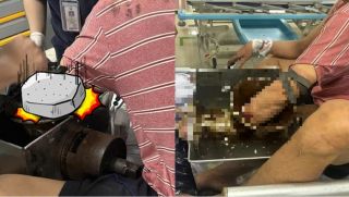 TP.HCM: Nam công nhân bị cuốn cả cánh tay vào máy xay thịt, ám ảnh tình trạng khi nhập viện cấp cứu