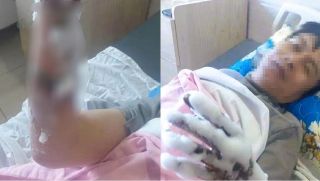 Thanh Hóa: Nam công nhân bỏng nặng 2 tay vì bị phóng điện, ngành chức năng công bố nguyên nhân