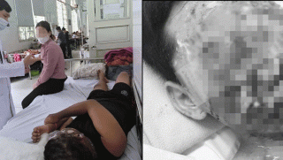 Gia đình xót xa khi mặt con trai bị biến dạng, chấn thương mắt nặng sau khi dùng pháo mua qua mạng