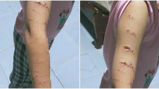 Giáo viên hoảng hốt phát hiện vết rạch chằng chịt trên tay của 1 học sinh lớp 5, sững sờ danh tính  người rạch
