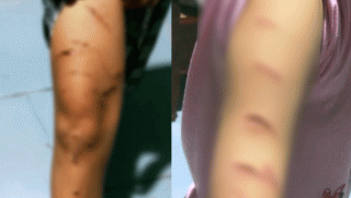 Chủ tịch UBND tỉnh Cà Mau lên tiếng vụ bé gái lớp 5 bị chị họ dùng dao cắt giấy rạch hàng trăm nhát