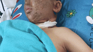 TP.HCM: Nam thanh niên mất một mắt sau khi thực hiện tục lệ quen thuộc ngày Tết, tình hình nạn nhân