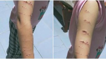 Giáo viên hoảng hốt phát hiện vết rạch chằng chịt trên tay của 1 học sinh lớp 5, sững sờ danh tính  người rạch