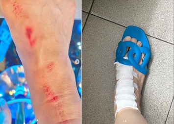Xót xa hình ảnh Hari Won bị thương: Chân phải băng bó, tay \'máu be ...