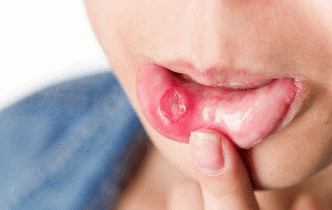 Đồng Tháp: Thanh niên 14 tuổi mắc HIV, 19 tuổi tá hỏa nhận kết quả nhiễm giang mai ác tính
