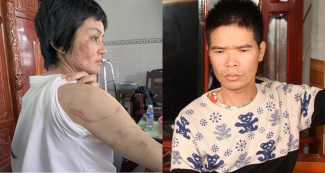 Chuyên gia choáng váng thốt lên 1 từ khi thấy vết thương của thai phụ 7 tháng bị tra tấn như nô lệ
