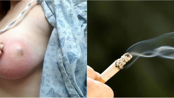 Hít khói thuốc lá từ chồng: Người vợ bị viêm tuyến vú, tiết mủ màu xanh