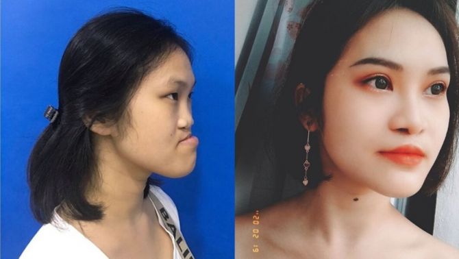 9x Phú Thọ 'đổi đời' sau 3 ca đại phẫu thay đổi hoàn toàn khuôn mặt