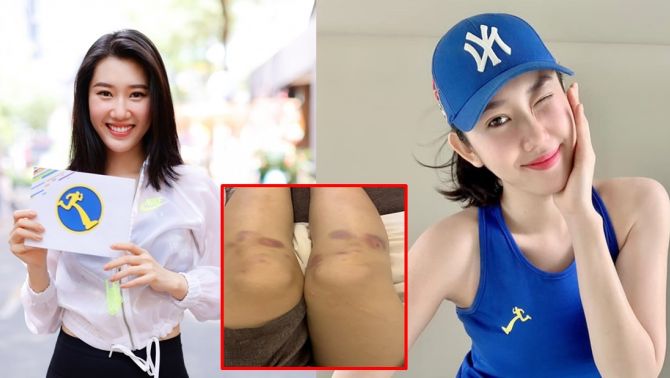 Thúy Ngân khiến fan xót xa khi đăng tải loạt ảnh quay chương trình khiến đôi chân bầm dập, tím tái