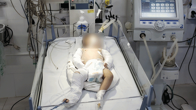 CĐM xót xa khi bé gái hơn 2 tháng tuổi nghi bị bạn trai mẹ đánh gãy xương tứ chi, chấn thương sọ não
