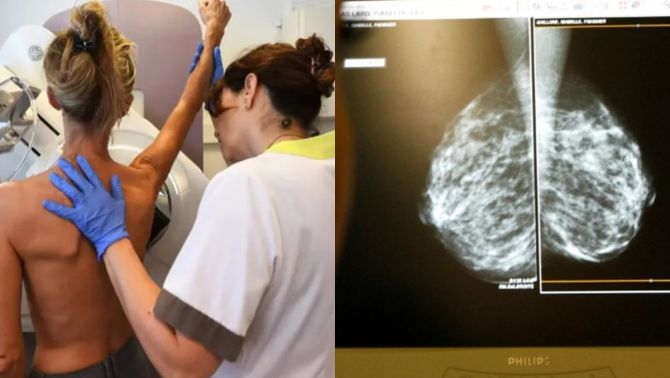 AI được ứng dụng để dự đoán ung thư vú di căn: Đang được thử nghiệm ở nhiều bệnh viện