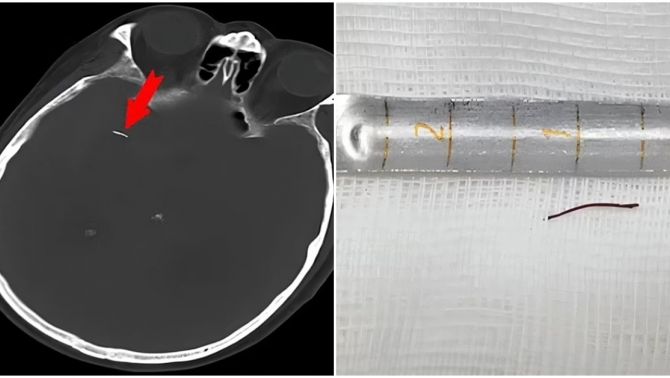 Cụ ông 74 tuổi bất ngờ phát hiện kim châm cứu nằm trong não đã 20 năm khi đi khám bệnh