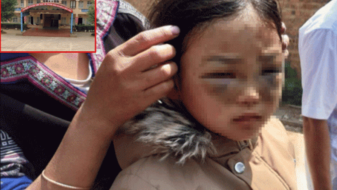 Yên Bái: Bé gái học lớp 1 nghi bị cô giáo chủ nhiệm đánh phải nhập viện điều trị