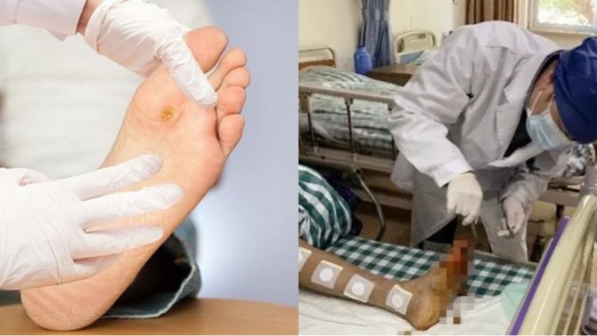 Người đàn ông phải cắt bỏ cả bàn chân chỉ vì thói quen sai lầm khi đi giày, nhiều người Việt Nam mắc phải