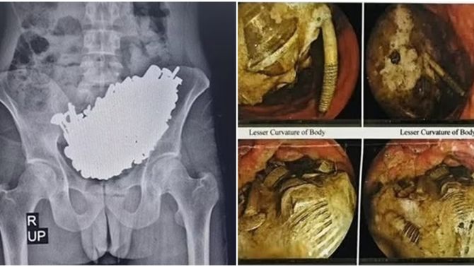 Sốc: Các bác sĩ lấy ra gần 3kg ốc vít, chìa khóa, kim loại từ dạ dày của 1 người đàn ông 37 tuổi