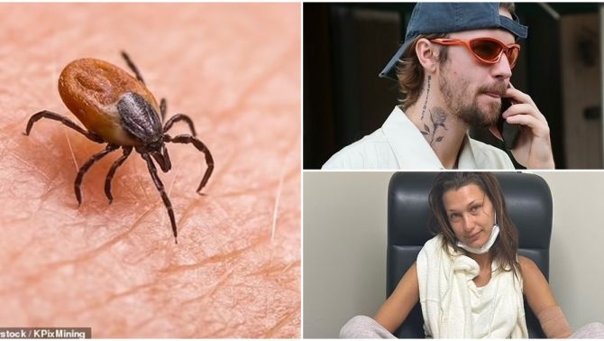 Justin Bieber, Bella Hadid và loạt ngôi sao đình đám mắc bệnh Lyme khó chữa do ve truyền