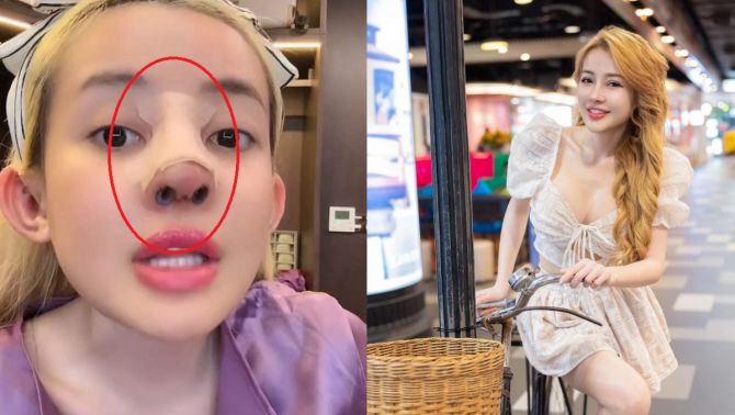 Biến chứng thẩm mỹ mũi khiến Ngân 98 đau đớn, ngất xỉu tại nhà riêng