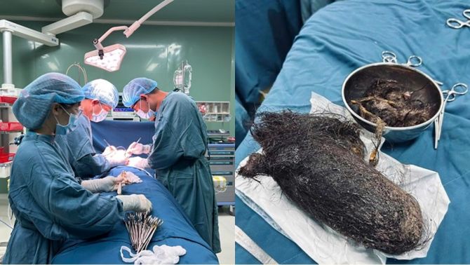 Sốc: Búi tóc nặng gần 1kg, gần như lấp toàn bộ dạ dày bé gái 12 tuổi ở Quảng Ngãi
