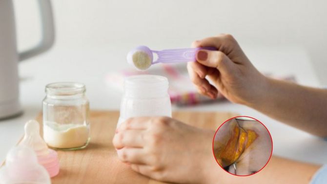 Trẻ 9 tháng tuổi ở Hà Nội bị bỏng nặng, gia đình bức xúc khi trường từ chối trách nhiệm, trường lên tiếng 'cực căng'