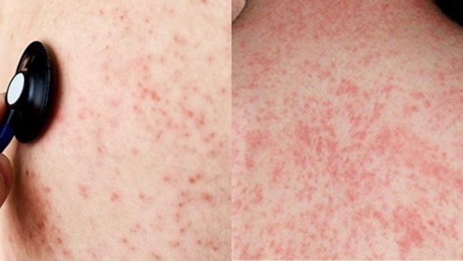 Số ca mắc sởi tăng nhanh, Bộ Y tế gửi thông báo khẩn tới tất cả bệnh viện trên toàn quốc