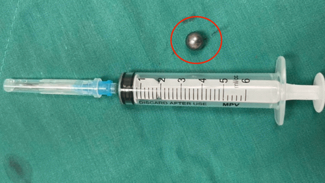 Thông tin mới nhất về vụ việc bé trai 5 tuổi bị viên đạn từ súng đồ chơi bắn xuyên thủng mặt