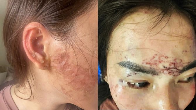 Chấn động vụ bắt cóc đánh ghen, tạt axit và xăm lên mặt ‘tình địch’ ở Cà Mau, công an vào cuộc