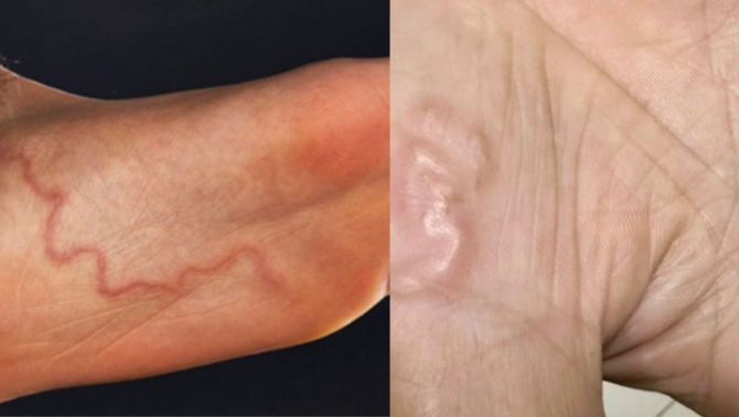 Sở thích ăn đồ sống có thể khiến bạn nhiễm giun rồng mà không hề hay biết