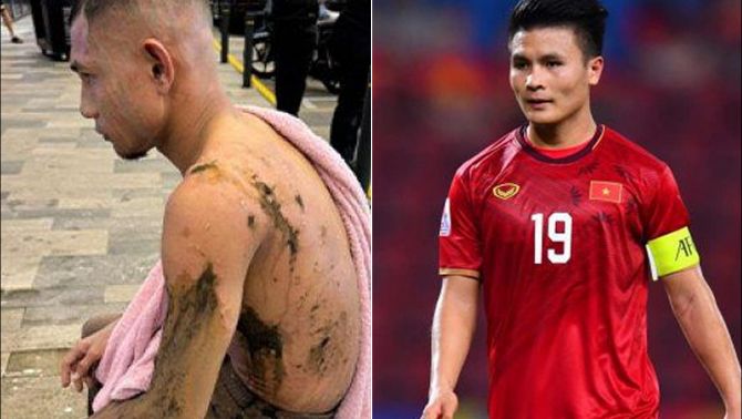 Trước thềm đấu ĐT Việt Nam, 'Ronaldo Malaysia' tái xuất với diện mạo khó tin sau khi bị tạt axit