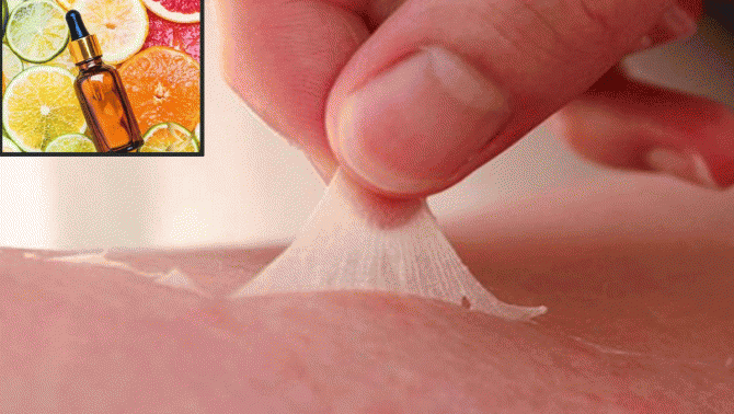 Tình hình hiện tại của cô gái bị bỏng toàn thân sau khi dùng ‘axit trái cây’ tẩy trắng da tại nhà