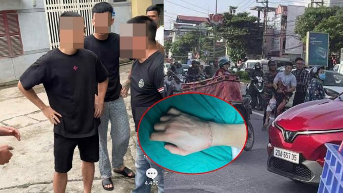 Bác sĩ hé lộ tình trạng sau ca mổ 6 tiếng của TikToker Hà Lits bị chém lìa tay ở Thái Nguyên