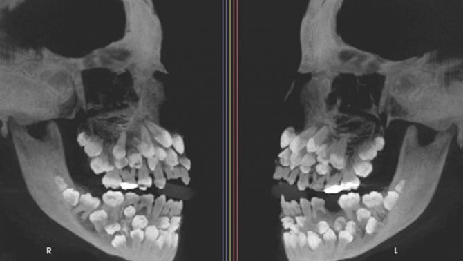 Bác sĩ giật mình khi phát hiện bé gái 11 tuổi có đến 81 chiếc răng, thách thức quá trình điều trị